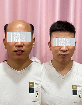 男士假发定制