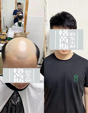男生增发可以试试物理增发织发补发产品，这种可以快速增加发量，达到密发效果