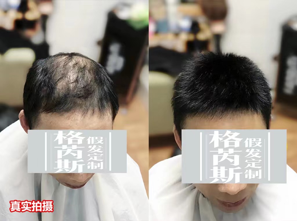 男士增发效果
