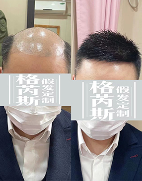 到店测量头型，根据脱发面积大小进行测量，获取补发重要数据